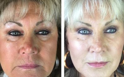 The Bobbi Bullock Medical Esthetics 45 Minute Miracle Medspa Facelift