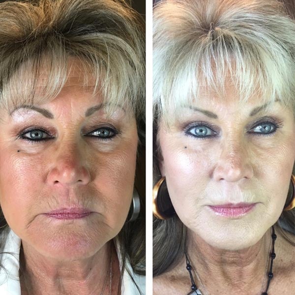 The Bobbi Bullock Medical Esthetics 45 Minute Miracle Medspa Facelift