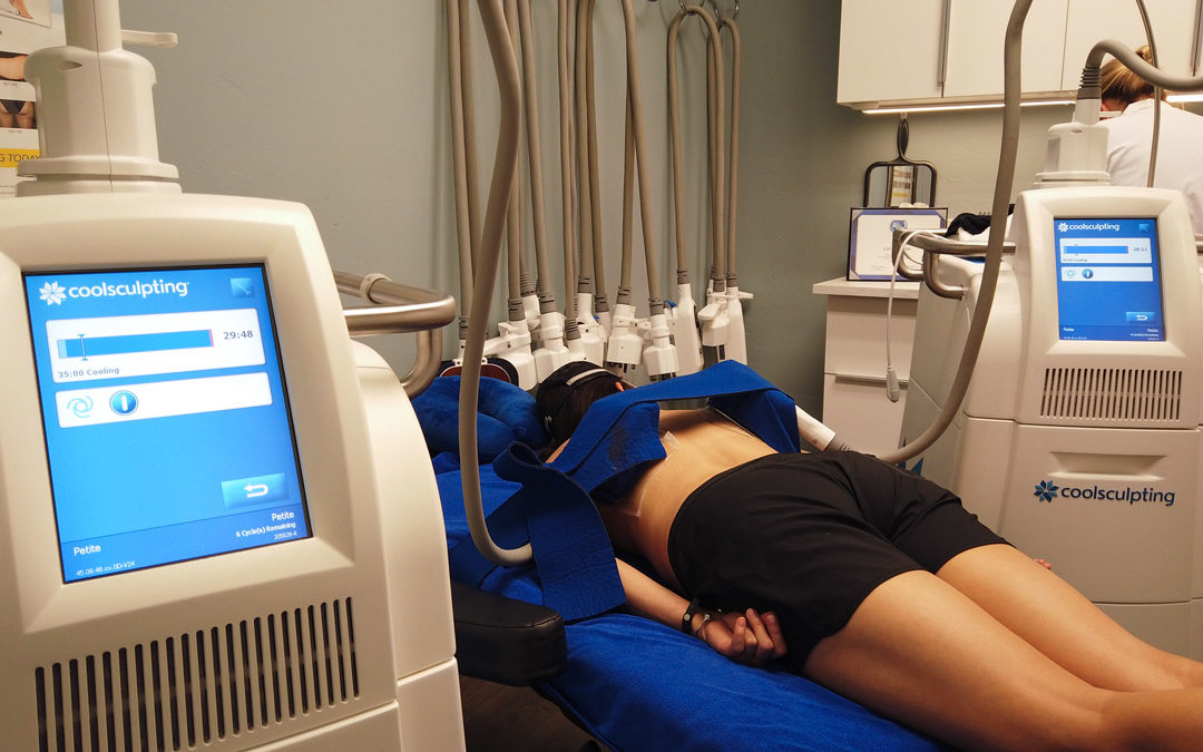 Should you lose weight before CoolSculpting?