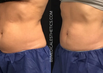 CoolSculpting before and after