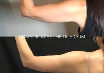 CoolSculpting before and after