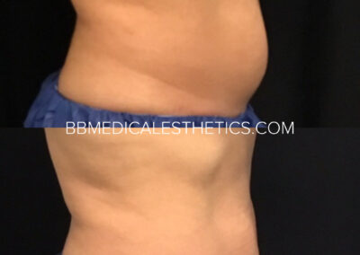 CoolSculpting before and after