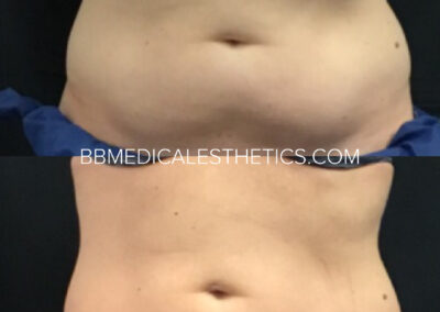 CoolSculpting before and after