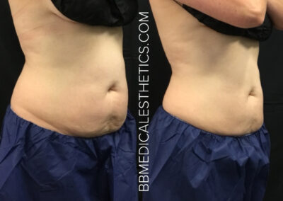CoolSculpting before and after