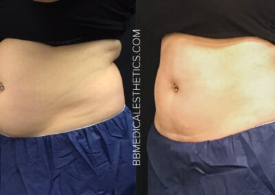 CoolSculpting before and after