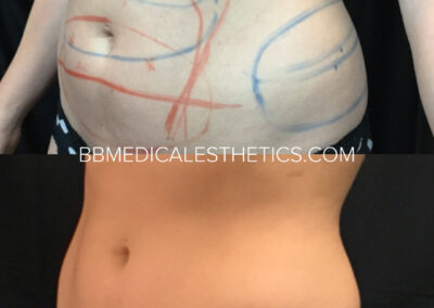 CoolSculpting before and after