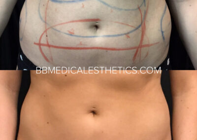 CoolSculpting before and after