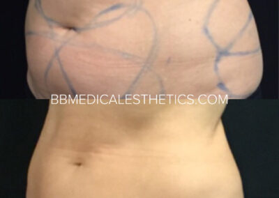 CoolSculpting before and after
