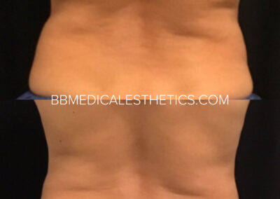 CoolSculpting before and after
