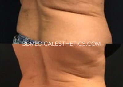 CoolSculpting before and after