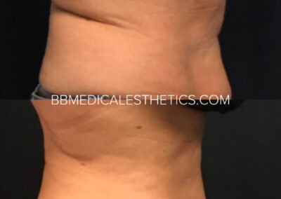 CoolSculpting before and after