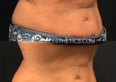 CoolSculpting before and after