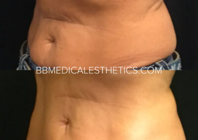 CoolSculpting before and after