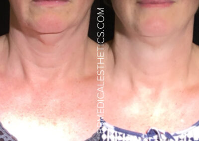 CoolSculpting before and after