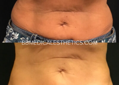 CoolSculpting before and after