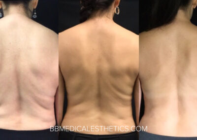 CoolSculpting before and after