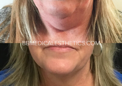 CoolSculpting before and after
