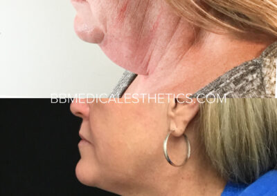 CoolSculpting before and after