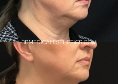 CoolSculpting before and after