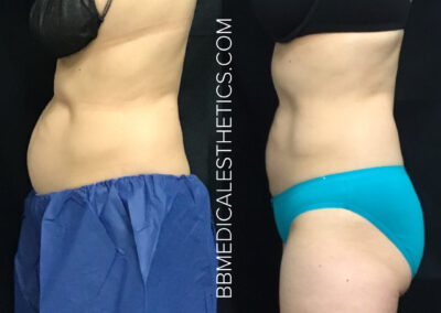 CoolSculpting before and after