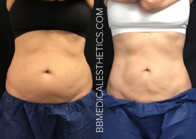 CoolSculpting before and after