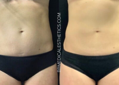 CoolSculpting before and after