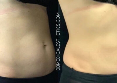 CoolSculpting before and after