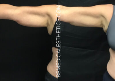 CoolSculpting before and after