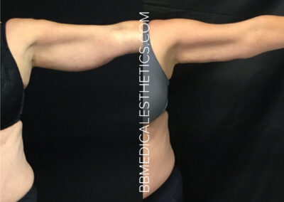 CoolSculpting before and after