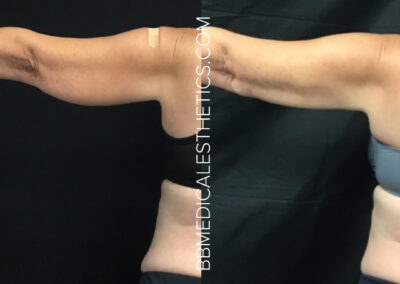 CoolSculpting before and after