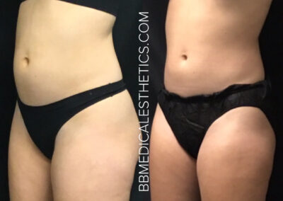 CoolSculpting before and after