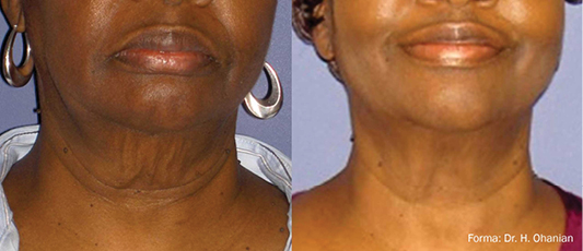 Forma Before After 1