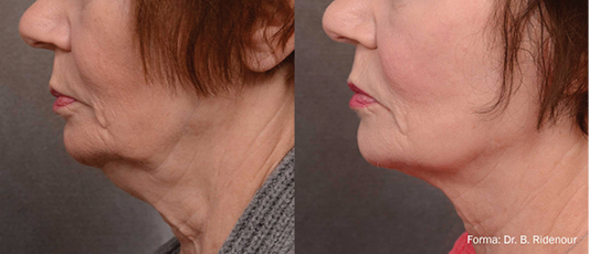 Forma Before After 2