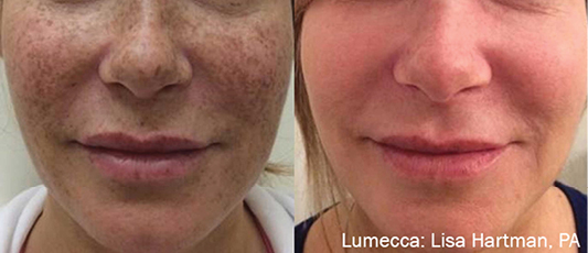Lumecca Before After 1