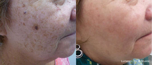Lumecca Before After 2