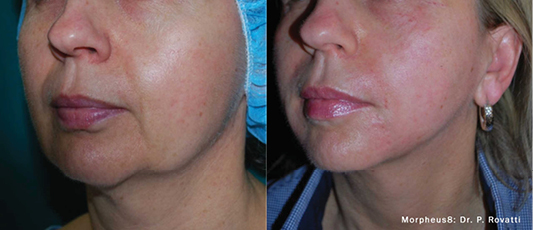 Optimas Before After 2