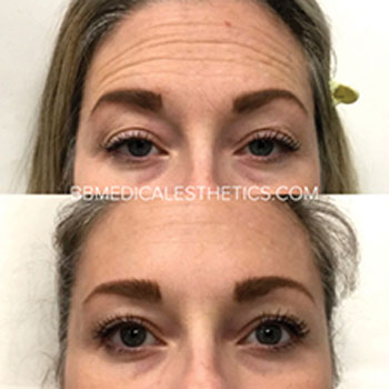 Botox-NewPage-Before-After-1