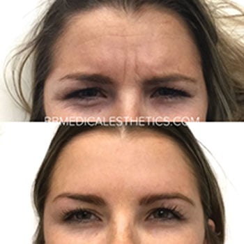 Botox-NewPage-Before-After-3