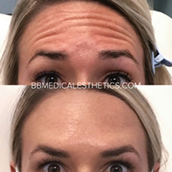 Botox-NewPage-Before-After-4