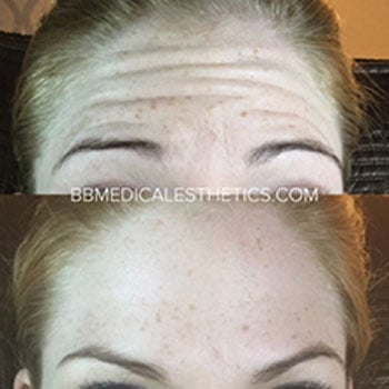 Botox-NewPage-Before-After-5