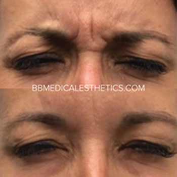 Botox-NewPage-Before-After-6