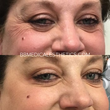 Botox-NewPage-Before-After-7