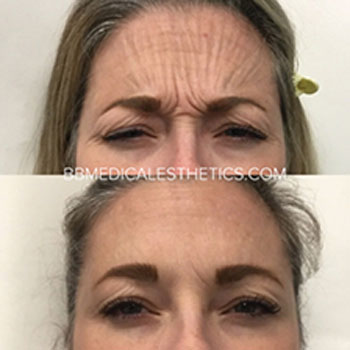 Botox-NewPage-Before-After-8