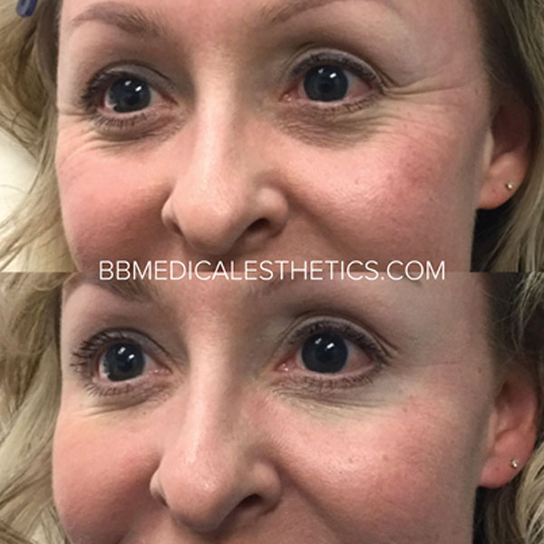 Botox-NewPage-Eye-Area