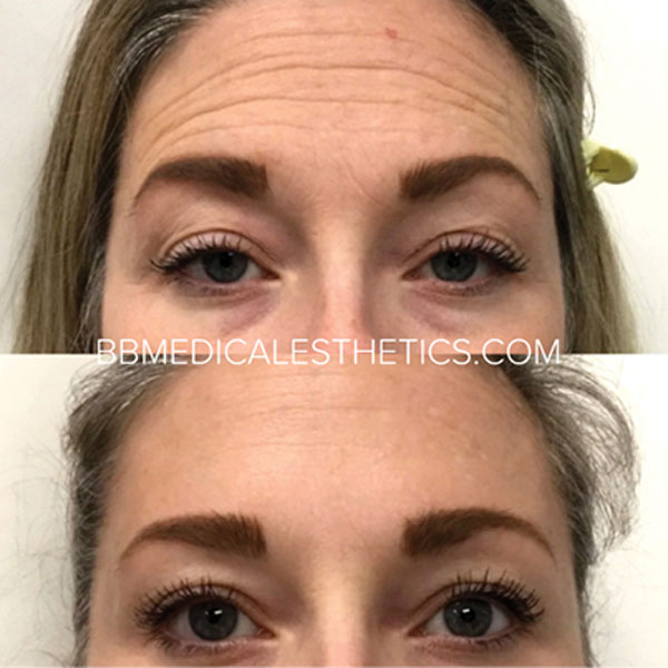 Botox-NewPage-Forehead-Line