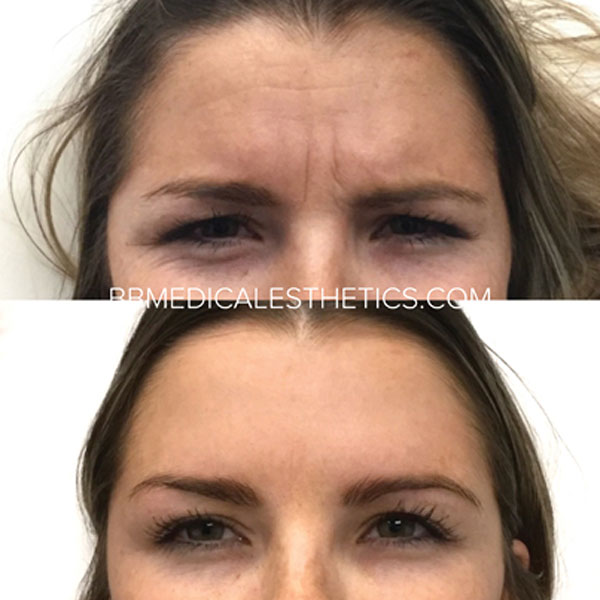 Botox-NewPage-Furrow-Lines