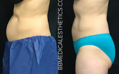 Why Your Choice of CoolSculpting Provider Matters