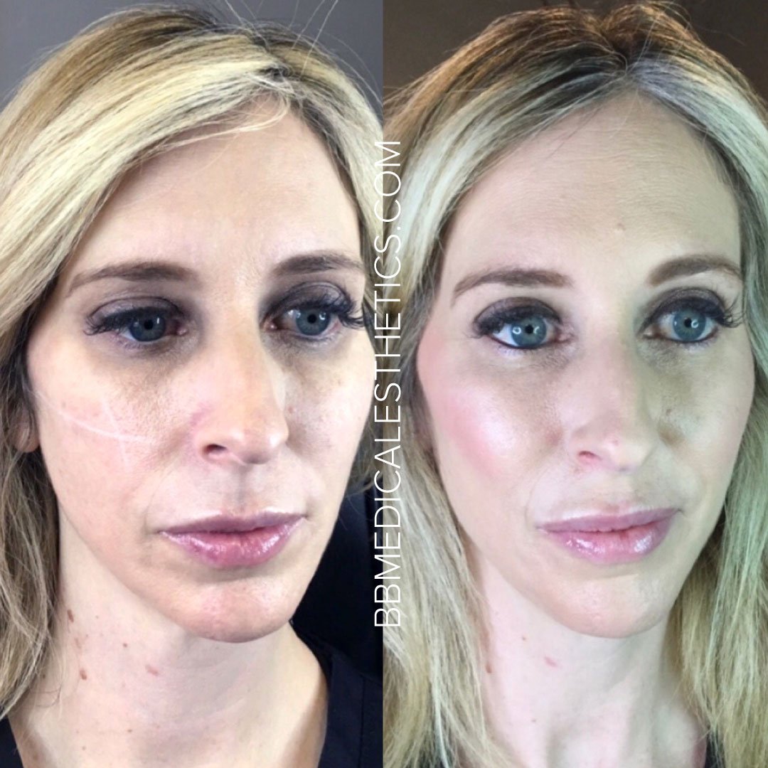 Dermal-B&A-3