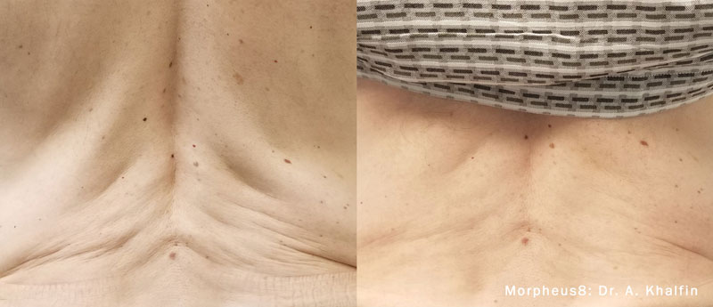 BetterBodyProgram-Morpheus8-BA-2