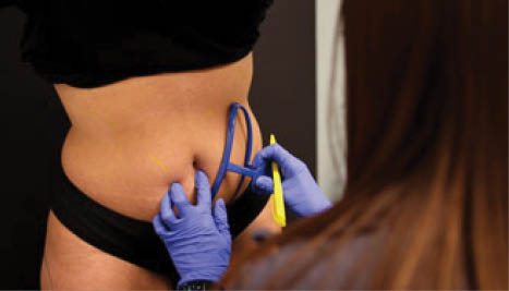 Coolsculpting-stomach